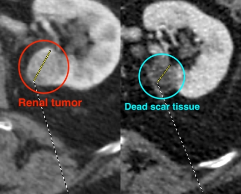 renal cancer cryoablation pre and post
