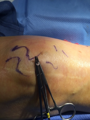 phlebectomy varicose veins