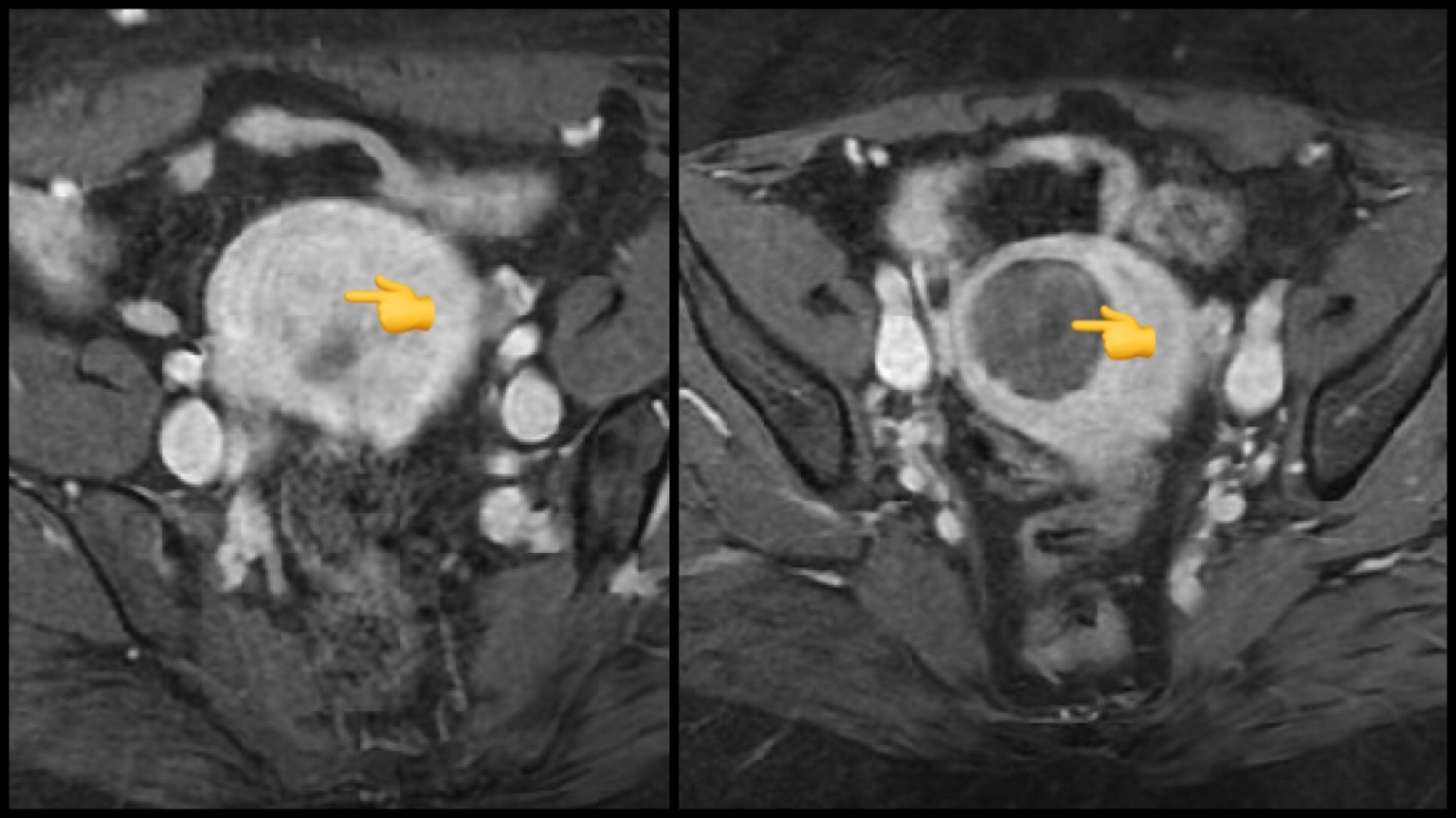 Uterine Fibroid Artery Embolization Specialist Uae Ufe