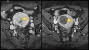 fibroid embolization pre and post