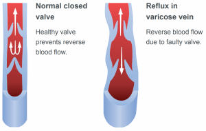 varicose veins