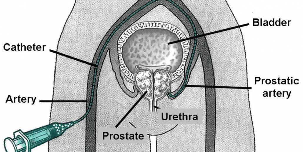 Prostate Artery Embolization Pae Versus Turp For An Enlarged Prostate Bph 5407