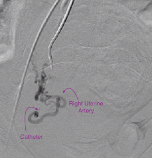 fibroid embolization