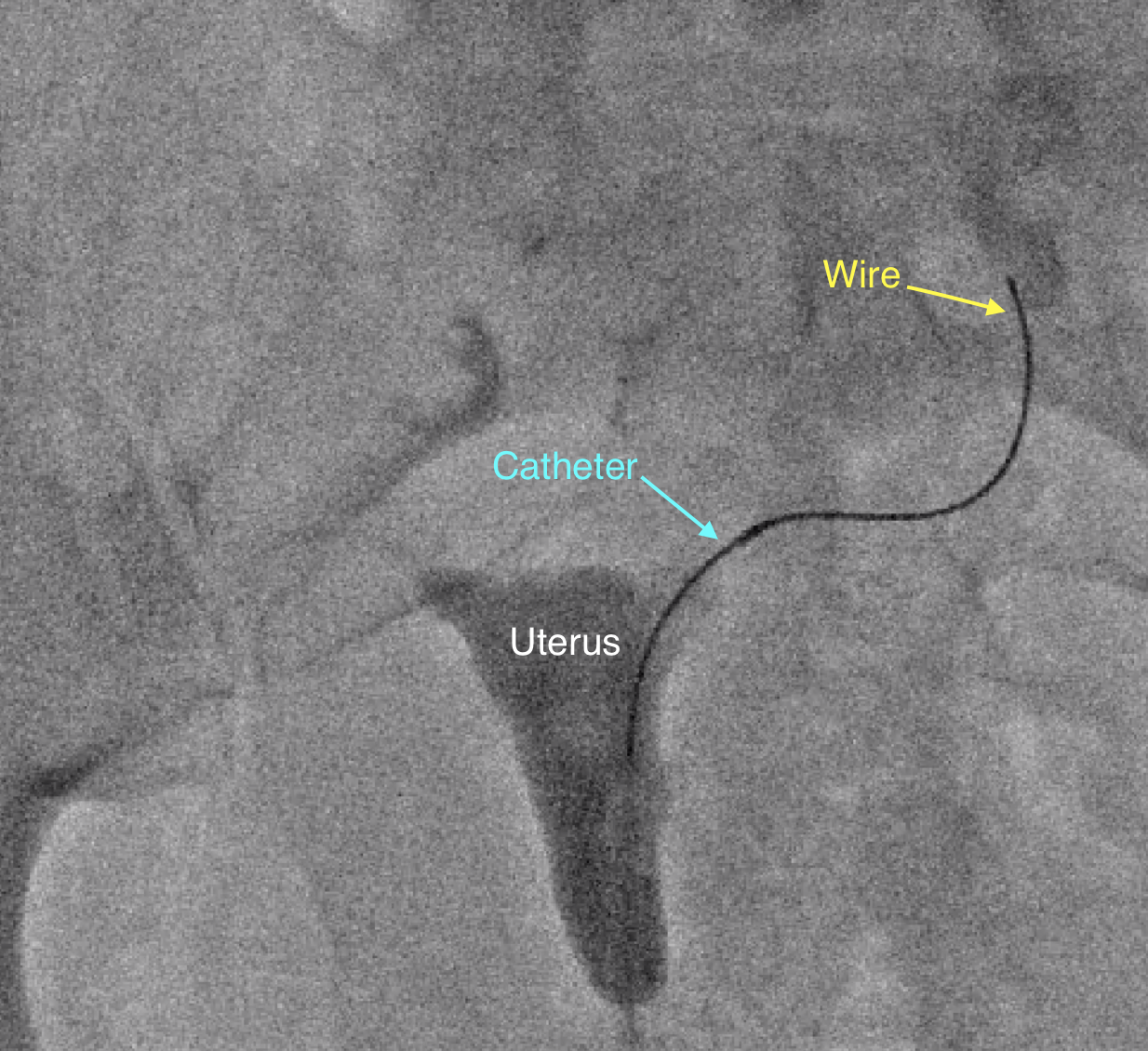 fallopian recanalization blockage catheter infertility vascular