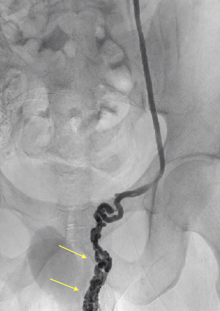 Varicocele Treatment Non Surgical Embolization Specialist