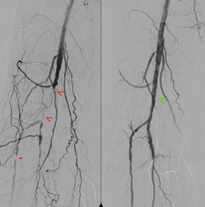 pvd tibial disease occlusions 