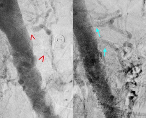 mesenteric ischemia stent placement treatment