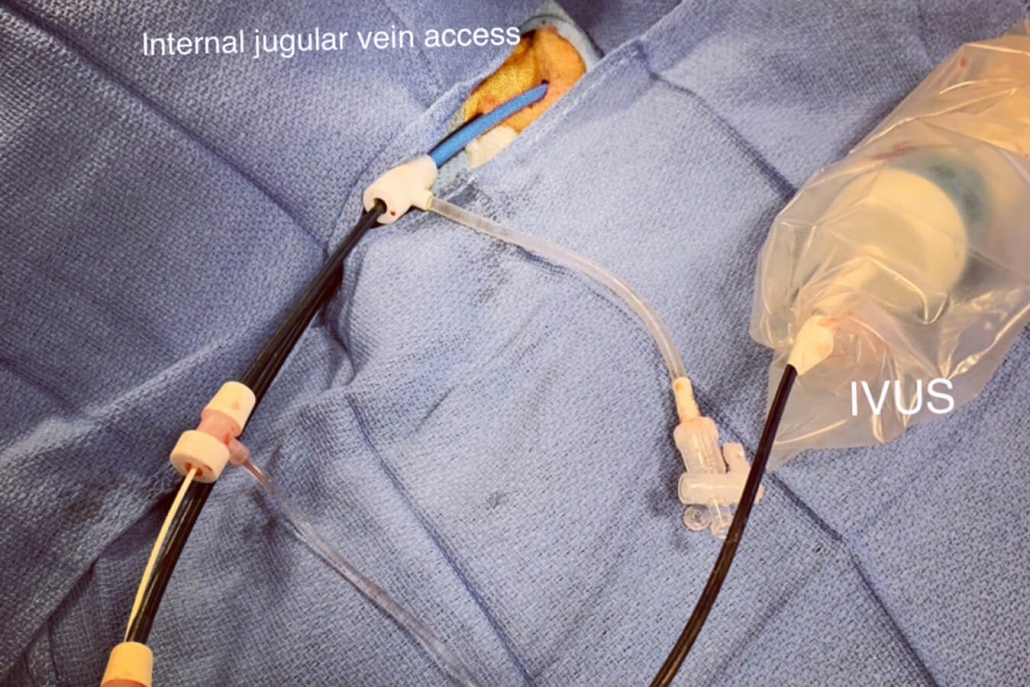 Tips Procedure Pressures Liver Cirrhosis: Essential Tips for Procedure