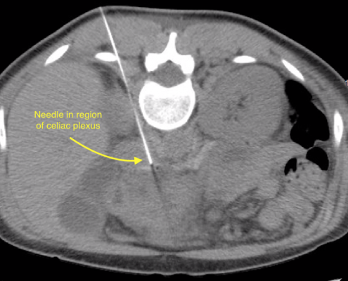 Celiac Plexus Block - Atabak Allaei, Md: Vascular & Image Guided 