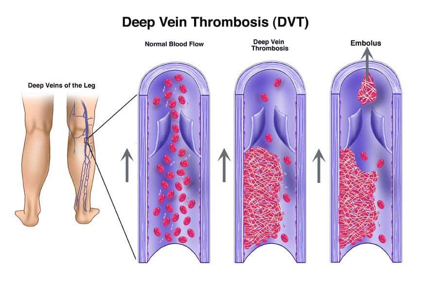 Understanding Dvt Causes Symptoms And Treatment Allaei Md