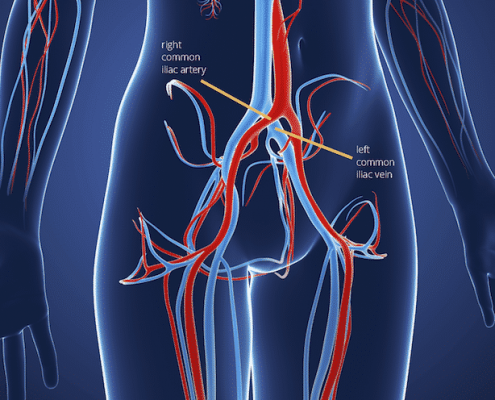 Venous Disease - Insights & Advanced Solutions | Allaei MD