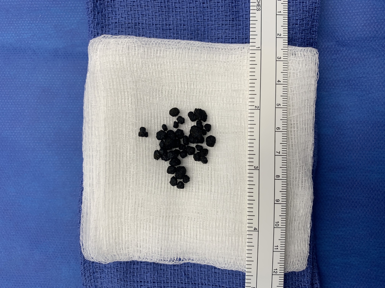 NonSurgical Gallstone Removal Cholangioscopy Technique