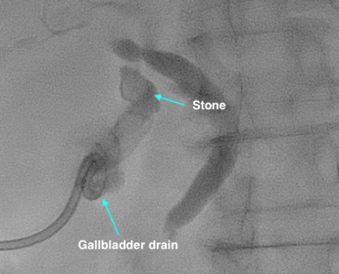 gallstone removal