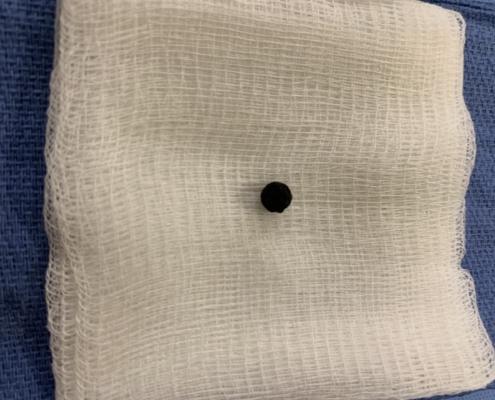 gallstone removal endoscopic california los Angeles san diego