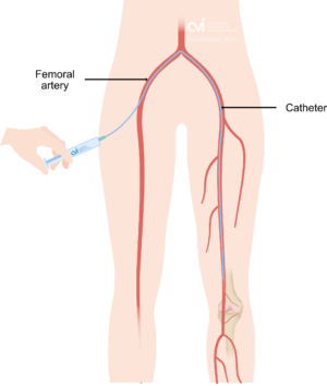 Geniculate Artery Embolization