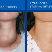 thyroid rfa before after